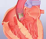 TMC News on artificial heart valve trials with Medtronic CoreValve