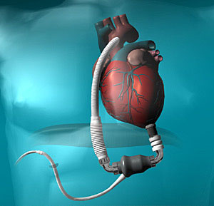 Thoratec HeartMate II left ventricular assist device (LVAD)