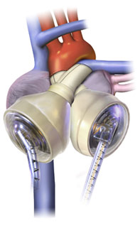 SynCardia temporary Total Artificial Heart (TAH)