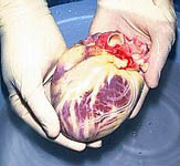 Donor heart prepared for transplantaion