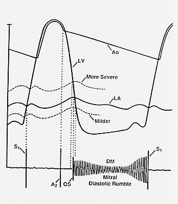 Diagram of opening snap of mitral valve stenosis