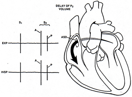 Desdoblamiento fijo y ancho del segundo ruido cardíaco