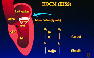 Diagram of auscultation of HOCM