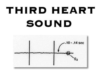 Diagram of third heart sound (S3).