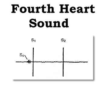 El cuarto ruido cardíaco