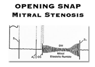 Chasquido de apertura estenosis mitral