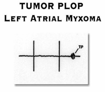 Plop tumoral Mixoma auricular izquierdo