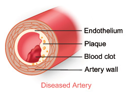 Coronary artery disease