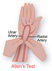 Allen's Test for Radial Artery Access