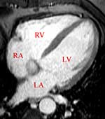 This MRI shows the four chambers of the heart. Click image for movie.