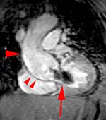 This MRI shows an aortic aneurysm and leaky aortic valve. Click image for movie.