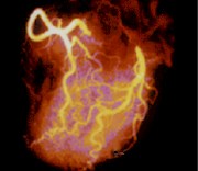 Enfermedad coronaria microvascular