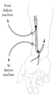 Illustration of an arteriovenous fistula or A-V fistula