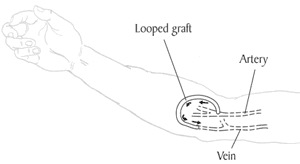 Illustration of an arteriovenous graft or A-V graft