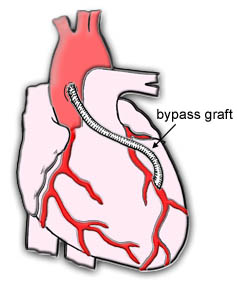 A coronary artery bypass graft from the aorta to the left anterior descending coronary artery