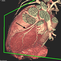 Esta imagen tridimensional de TCMD presenta el ventrículo izquierdo visto desde arriba. Muestra una arteria coronaria normal (flecha negra) y sus ramas laterales. 