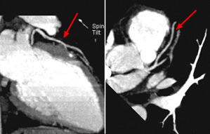Las dos imágenes de TCMD superiores muestran que la arteria coronaria izquierda (flechas rojas) y sus ramas laterales son normales. 