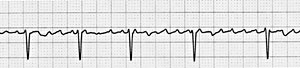 Photo of an electrocardiogram (ECG or EKG) tracing.