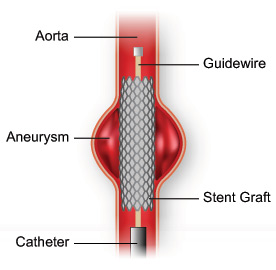 Illustration of a stent graft placed in an aneurysm.