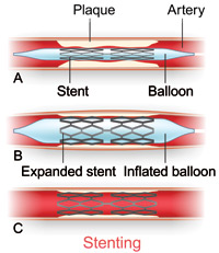Illustration of the stenting procedure