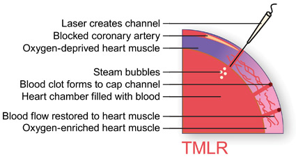 Illustration of transmyocardial laser revascularization (TMLR).
