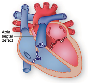 Illustration showing atrial septal defect.