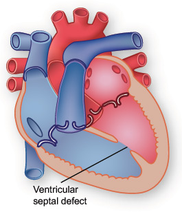 Illustration showing ventricular septal defect.