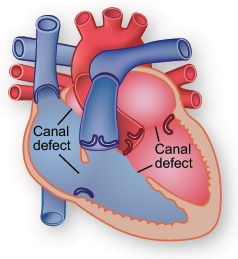 Illustration showing canal defect.