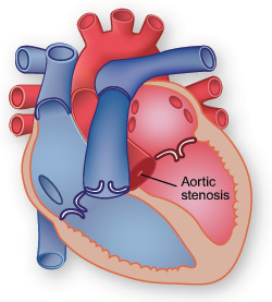 Illustration showing aortic stenosis.