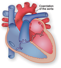 Illustration showing coarctation of the aorta.