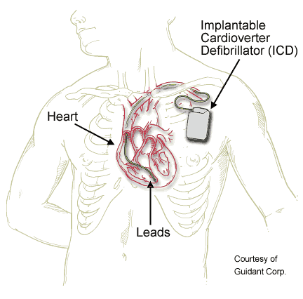 The ICD is implanted beneath the skin and the leads are placed inside the heart or on its surface.