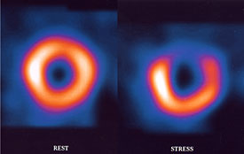 Images taken at rest and during exercise from a nuclear stress test. The dark area shows a location where blood flow is abnormal.