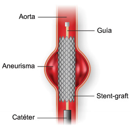 Ilustracion de un stent-graft colocado en un aneurisma.