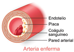 La enfermedad arterial coronaria (EAC)