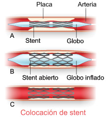 La angioplastia con balón se complementa con la colocación de un stent.