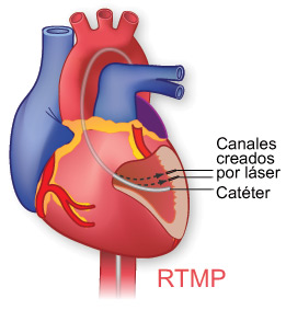 La revascularización transmiocárdica percutánea (RTMP)