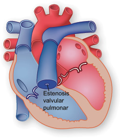 Ilustracion de una estenosis valvular pulmonar.