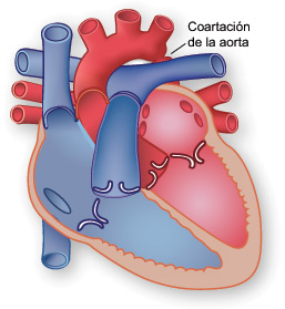 Ilustración de una coartación de la aorta.