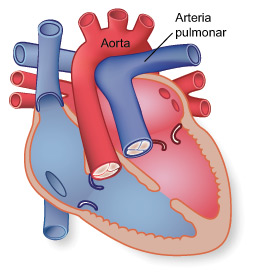 Ilustracion que muestra la transposicion de las grandes arterias.