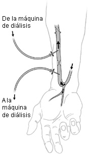 Ilustraciýn de una fýstula arteriovenosa o fýstula AV.