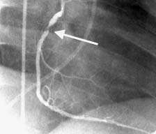Foto de un angiograma coronario. La flecha indica una obstruccion en la arteria coronaria derecha.