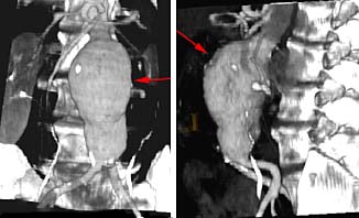 Las flechas rojas en las imýgenes indican un aneurisma de gran tamaýo en la aorta abdominal, vista de frente (imagen izquierda) y de perfil (imagen derecha).