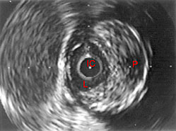 Imagen por ultrasonido intravascular que muestra el interior de una arteria coronaria.