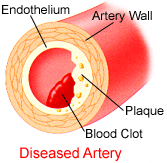 Illustration showing a diseased coronary artery.