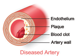 Diagram of a diseased artery