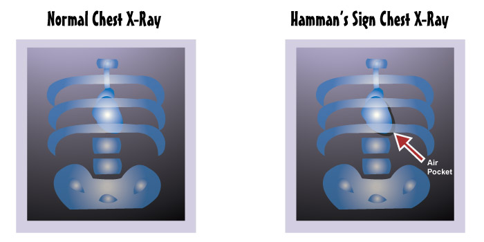 Hamman's Sign Chest X-ray
