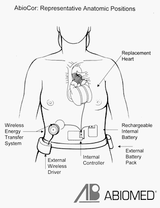 Diagram of the AbioCor implantable replacement heart system