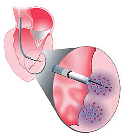 Drawing of a NOGA TM Myostar catheter injecting stem cells into the heart.
