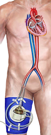 Illustration of the TandemHeart pVAD.